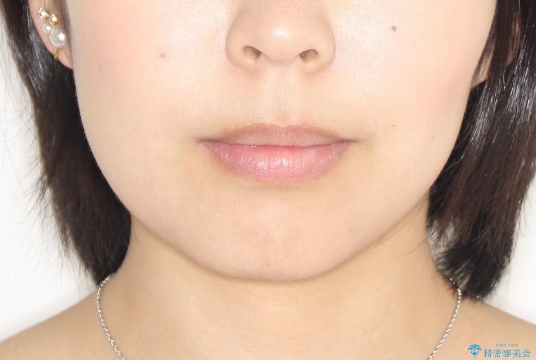 八重歯・下の前歯が2本足りない(20代女性)・ILFsystem・審美装置の治療後（顔貌）