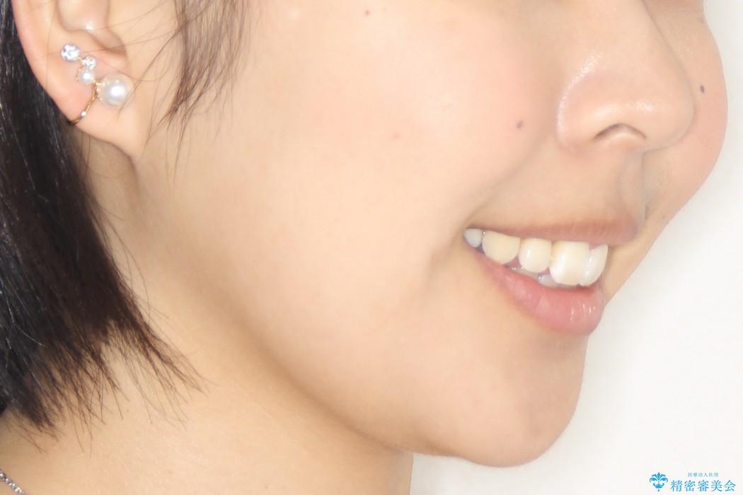八重歯・下の前歯が2本足りない(20代女性)・ILFsystem・審美装置の治療後（顔貌）