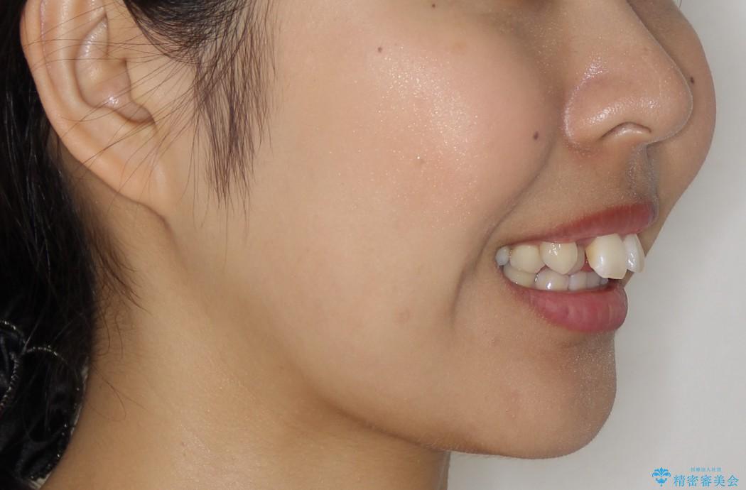 八重歯・下の前歯が2本足りない(20代女性)・ILFsystem・審美装置の治療前（顔貌）