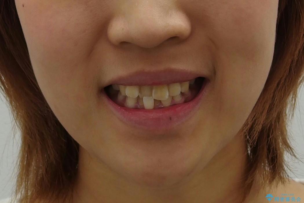 前歯のがたがた　歯を抜かない矯正治療(治療期間10ヶ月)の治療前（顔貌）