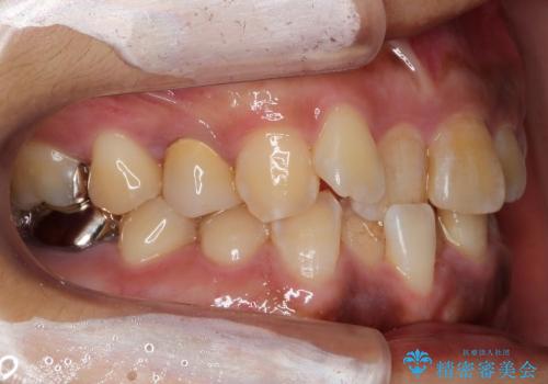 前歯のがたがた　歯を抜かない矯正治療(治療期間10ヶ月)の治療前