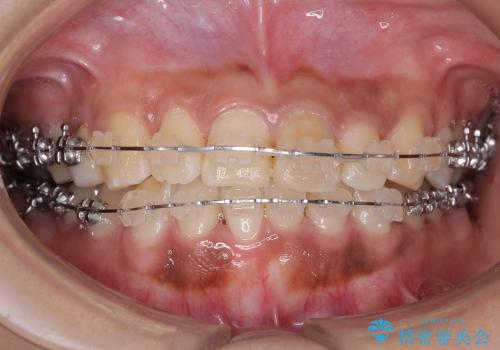 前歯のがたがた　歯を抜かない矯正治療(治療期間10ヶ月)の治療中