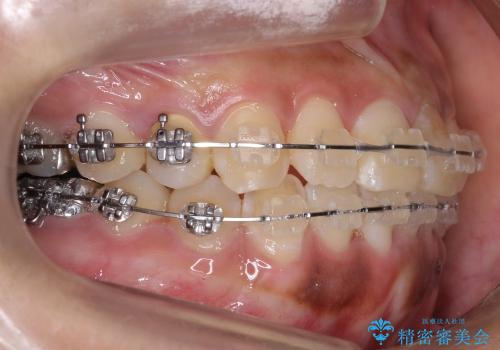前歯のがたがた　歯を抜かない矯正治療(治療期間10ヶ月)の治療中