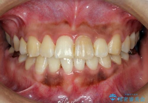 前歯のがたがた　歯を抜かない矯正治療(治療期間10ヶ月)の治療後