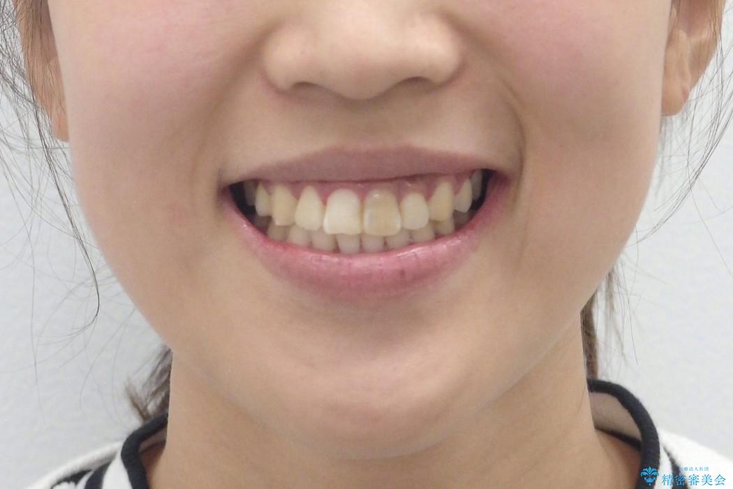 前歯のがたがた　歯を抜かない矯正治療(治療期間10ヶ月)の治療後（顔貌）