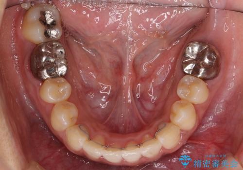 前歯のがたがた　歯を抜かない矯正治療(治療期間10ヶ月)の治療後