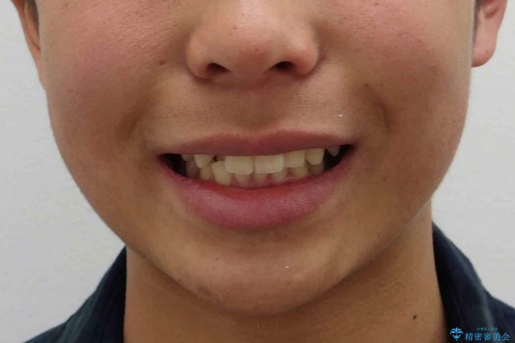 前歯のがたがた　出っ歯の治療前（顔貌）