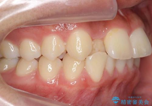 前歯のがたがた　出っ歯の治療前