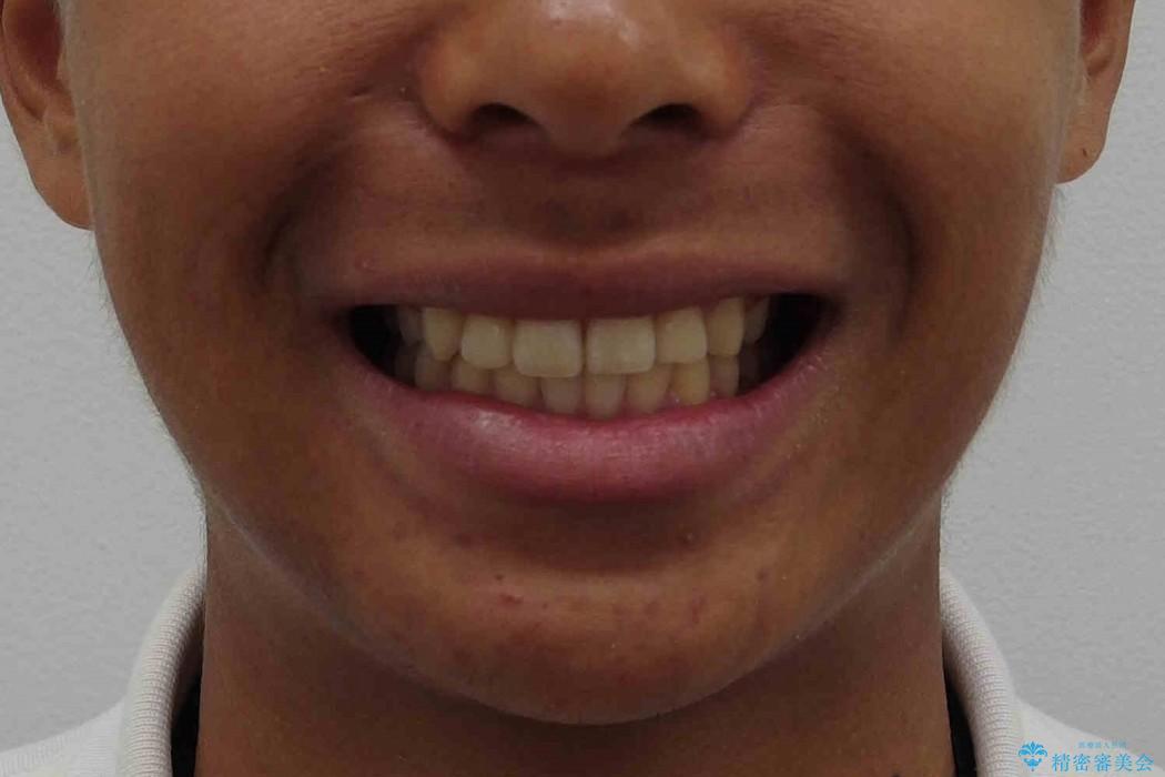 前歯のがたがた　出っ歯の治療後（顔貌）