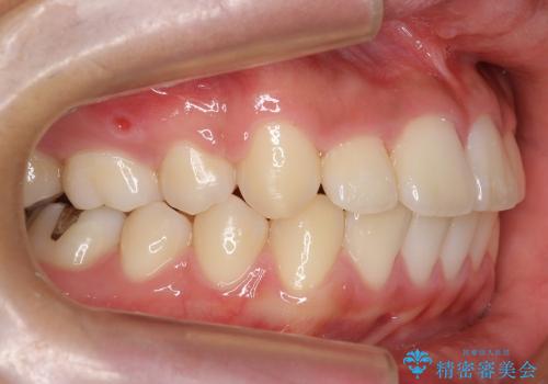 前歯のがたがた　出っ歯の治療後