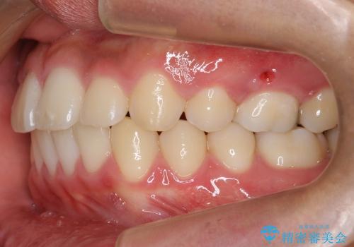 前歯のがたがた　出っ歯の治療後
