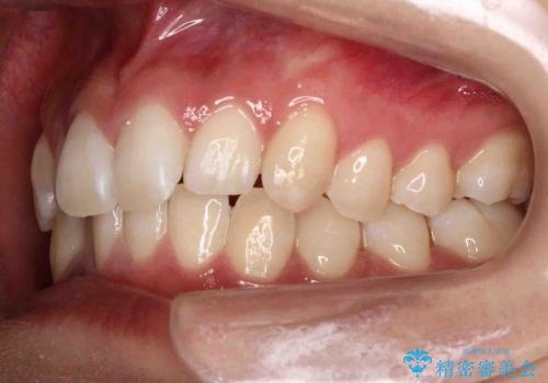 [20代女性] 前歯のがたがた　歯を抜かない矯正治療の治療前