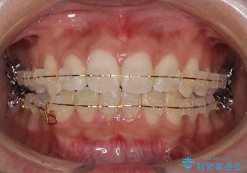 [20代女性] 前歯のがたがた　歯を抜かない矯正治療の治療中