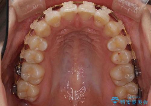 [20代女性] 前歯のがたがた　歯を抜かない矯正治療の治療中
