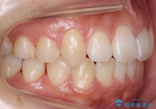 [20代女性] 前歯のがたがた　歯を抜かない矯正治療の治療後