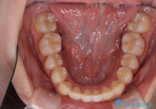 [20代女性] 前歯のがたがた　歯を抜かない矯正治療の治療後