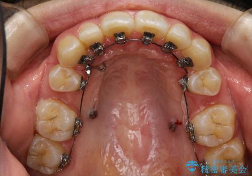 出っ歯・20代女性・裏側矯正・抜歯ケース・マイクロインプラント・2年の治療中