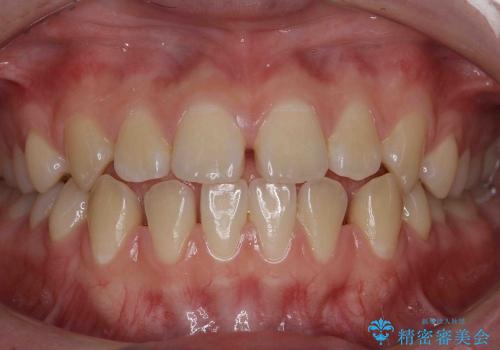 すきっ歯　歯を抜かない矯正治療の治療前