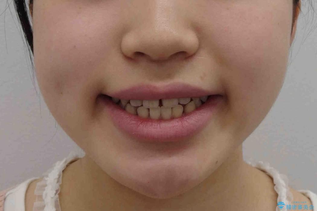 すきっ歯　歯を抜かない矯正治療の治療前（顔貌）