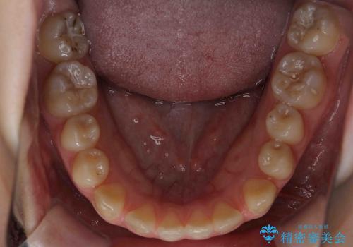 すきっ歯　歯を抜かない矯正治療の治療前