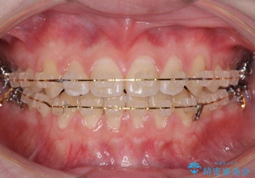 すきっ歯　歯を抜かない矯正治療の治療中