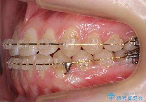 すきっ歯　歯を抜かない矯正治療の治療中