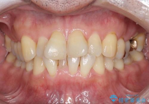 歯を抜かない矯正治療　銀歯を白く　50代でも若返りますの治療前