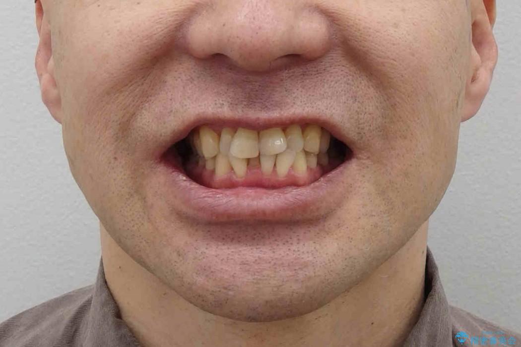 歯を抜かない矯正治療　銀歯を白く　50代でも若返りますの治療前（顔貌）