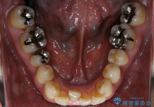歯を抜かない矯正治療　銀歯を白く　50代でも若返りますの治療前