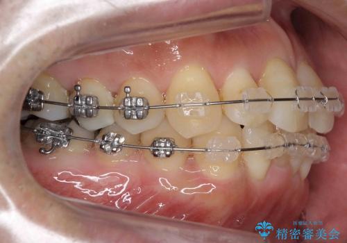 歯を抜かない矯正治療　銀歯を白く　50代でも若返りますの治療中
