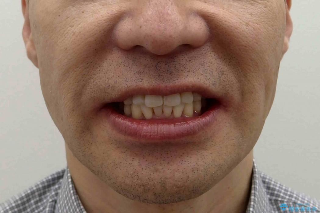 歯を抜かない矯正治療　銀歯を白く　50代でも若返りますの治療後（顔貌）