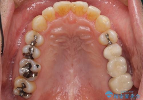 歯を抜かない矯正治療　銀歯を白く　50代でも若返りますの治療後