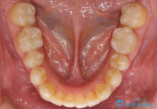 歯を抜かない矯正治療　銀歯を白く　50代でも若返りますの治療後