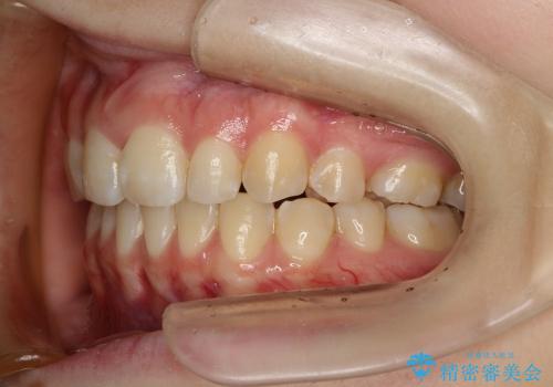 出っ歯・20代女性・裏側矯正・抜歯ケース・マイクロインプラント・2年の治療後