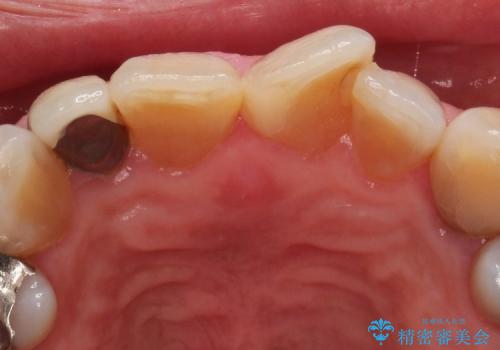 前歯6本のオールセラミック(50代女性)の治療前