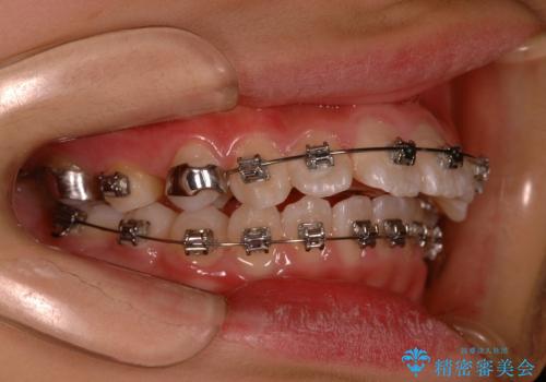 出っ歯(上顎前突)・ペンデュラム装置・メタル・小児矯正・非抜歯の治療中