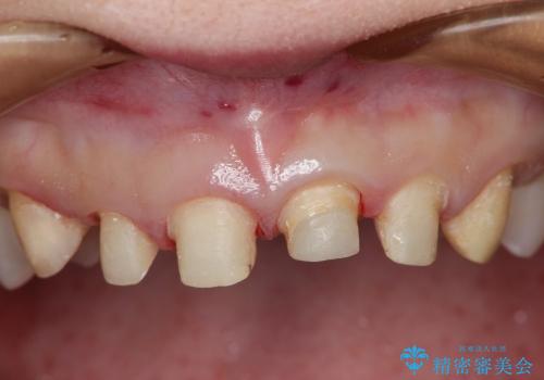歯ぐきのラインを整えた前歯セラミック治療の治療中