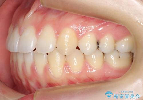 すきっ歯　歯を抜かない矯正治療の治療後