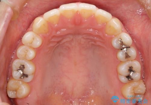 すきっ歯　歯を抜かない矯正治療の治療後