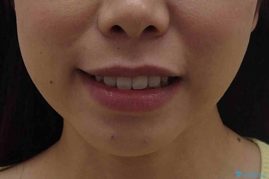 すきっ歯　歯を抜かない矯正治療の治療後（顔貌）