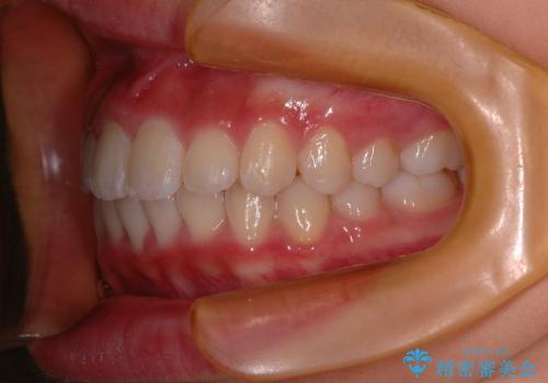 出っ歯(上顎前突)・ペンデュラム装置・メタル・小児矯正・非抜歯の治療後