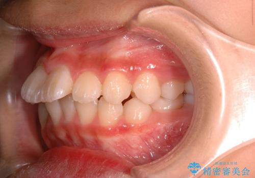 出っ歯(上顎前突)・ペンデュラム装置・メタル・小児矯正・非抜歯の治療前
