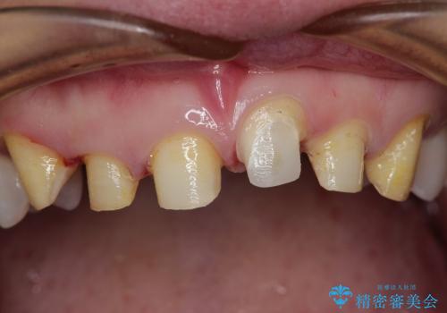 歯ぐきのラインを整えた前歯セラミック治療の治療前