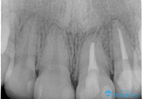前歯や奥歯のむし歯治療(20代女性)の治療後