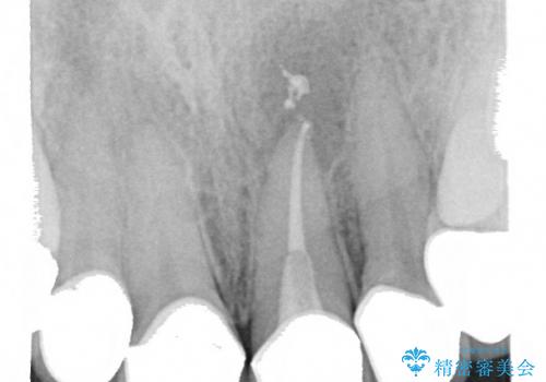 歯ぐきのラインを整えた前歯セラミック治療の治療後