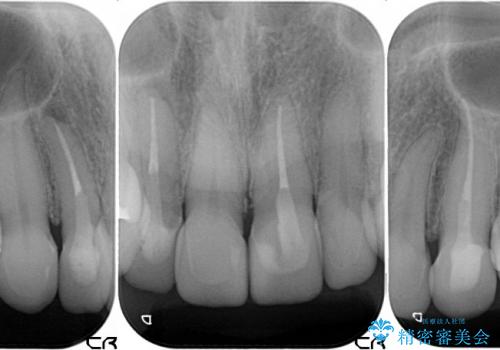 前歯6本のオールセラミック(50代女性)の治療後