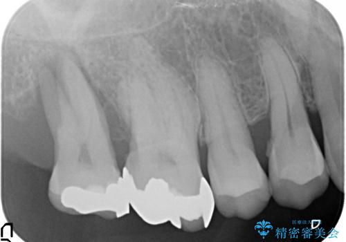 歯周病で抜歯した歯への自家歯牙移植による咬合回復の治療前