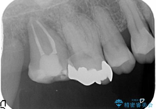 歯周病で抜歯した歯への自家歯牙移植による咬合回復の治療中