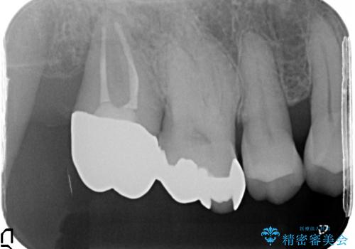 歯周病で抜歯した歯への自家歯牙移植による咬合回復の治療後