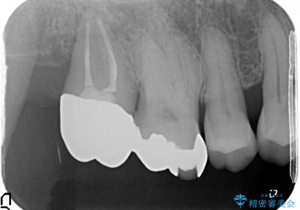 歯周病で抜歯した歯への自家歯牙移植による咬合回復